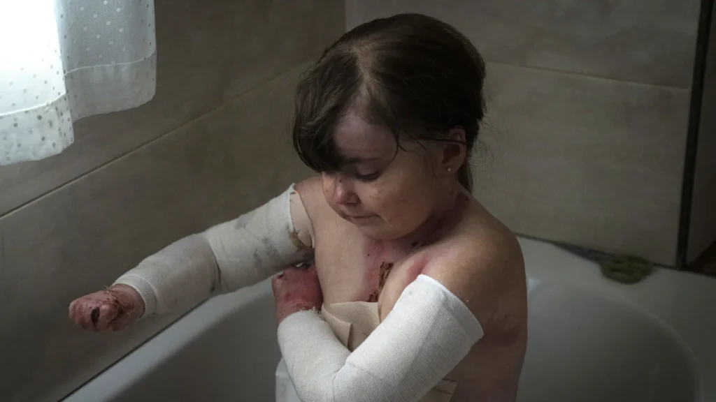 Elena, afectado por piel de mariposa sentada en la bañera